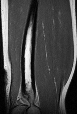 Figure 3 for case Osteoid Osteoma